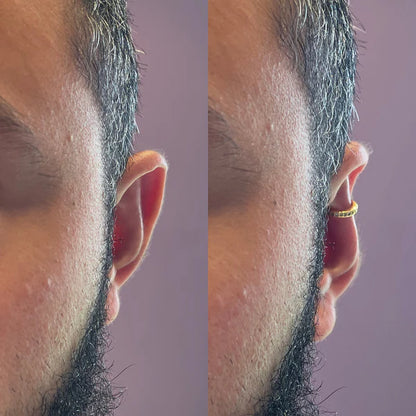 Earfix – Il Correttore Riutilizzabile per Orecchie per Risultati Naturali